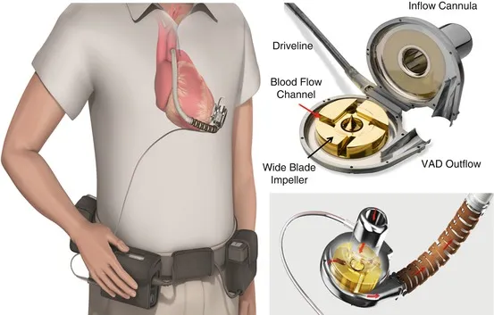 The impeller of blood pump in VAD