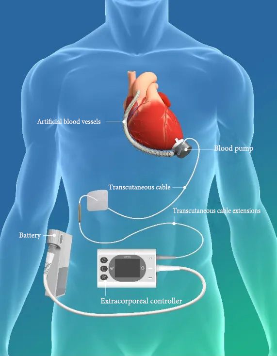 Left Ventricular Assist System BrioVAD™ Product Schematic