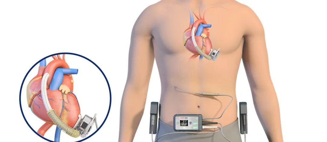 CH® Implantable Left Ventricular Assist System (CH-VAD)