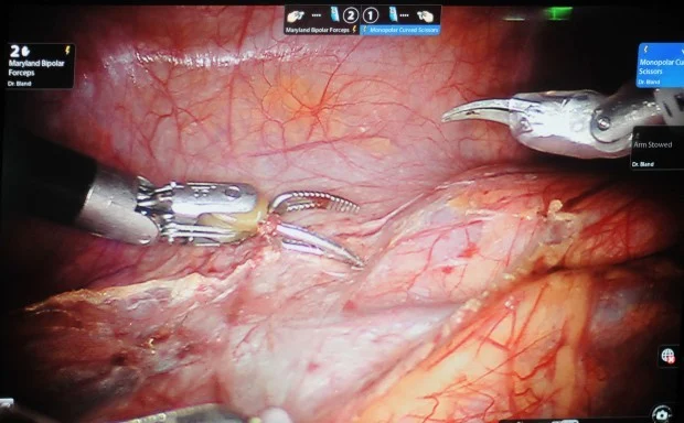 the view in robot-assisted surgery