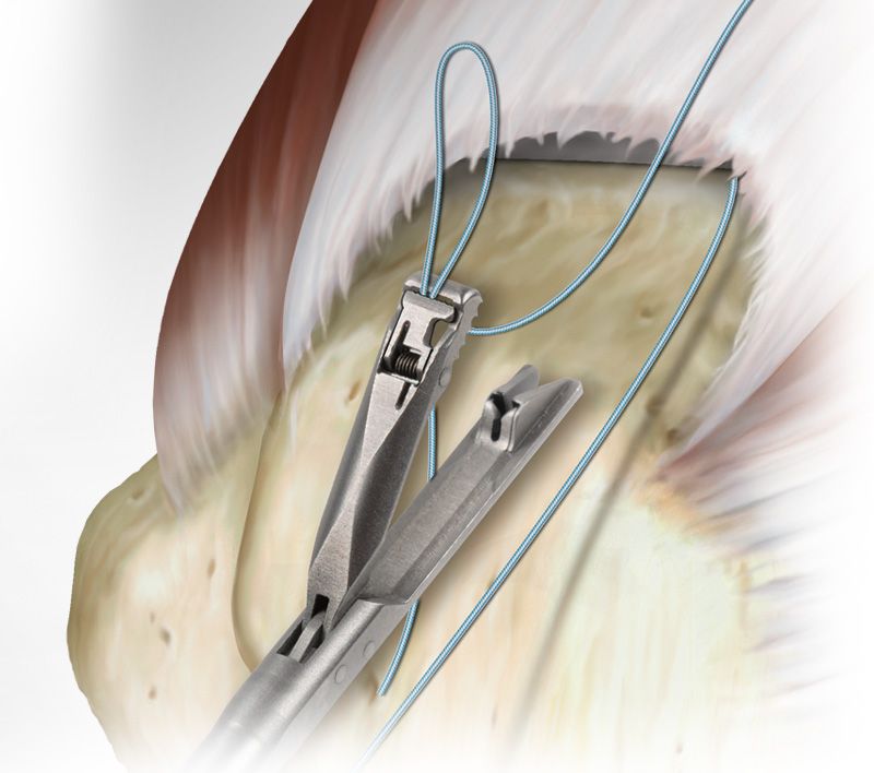 Suture Passers in joint surgery