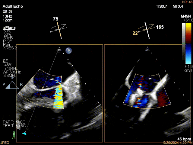 Mitral Clip Release