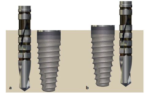 Implants placed below and above the alveolar crest