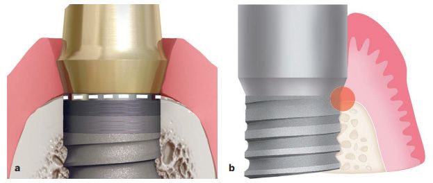 Implant-abutment interface placed at or near the bone level