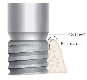 Micro-leakage at the implant-abutment interface