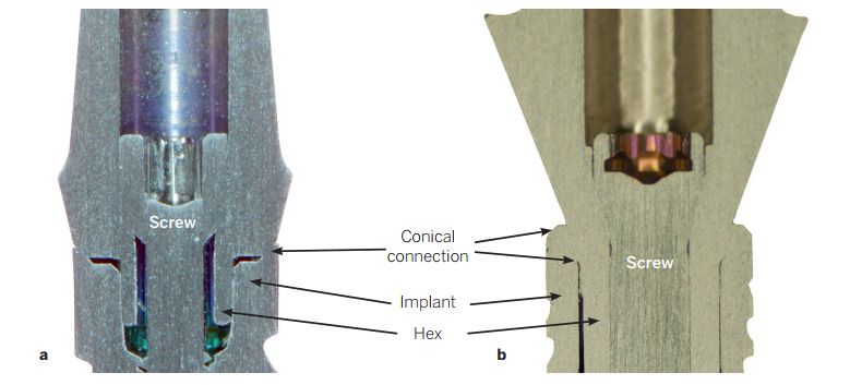 Different types of implant-abutment connections