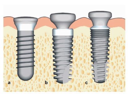 Different implant neck types