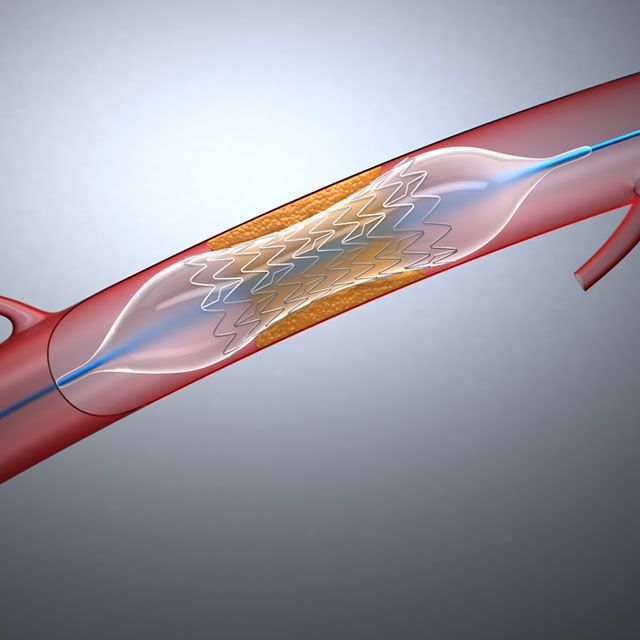 Heart Stents (Stent)