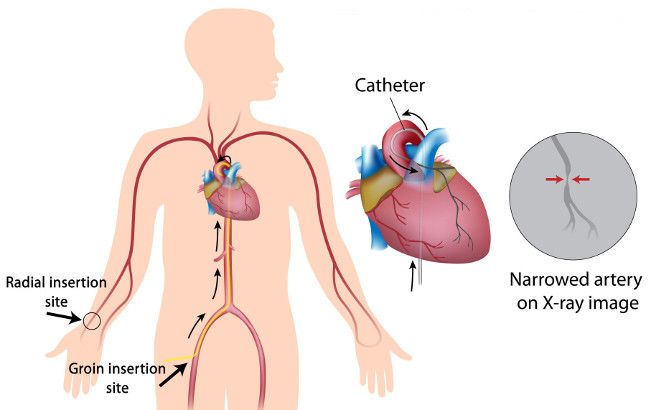 radial insertion and groin insertion