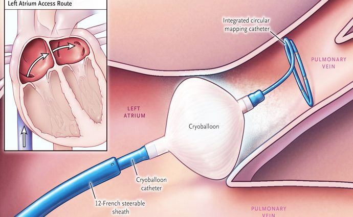 Ablation, Cryoablation