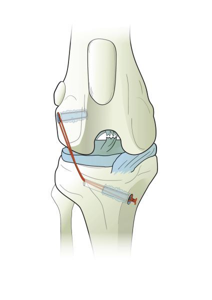 Ti-Force Full Thread Anchors used in joint ligament repair