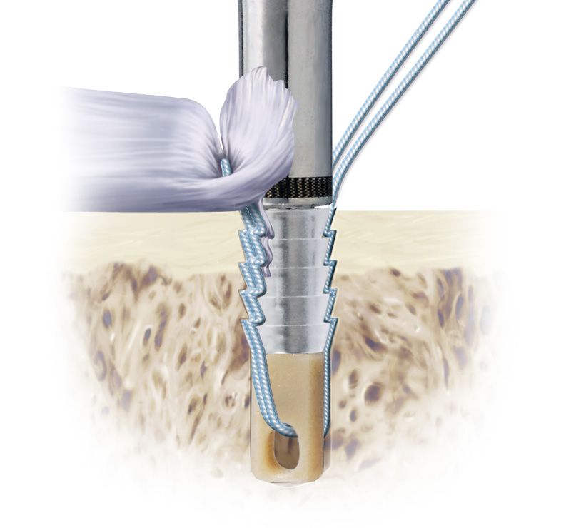 Bio-Force Soft Anchor in surgical scenarios