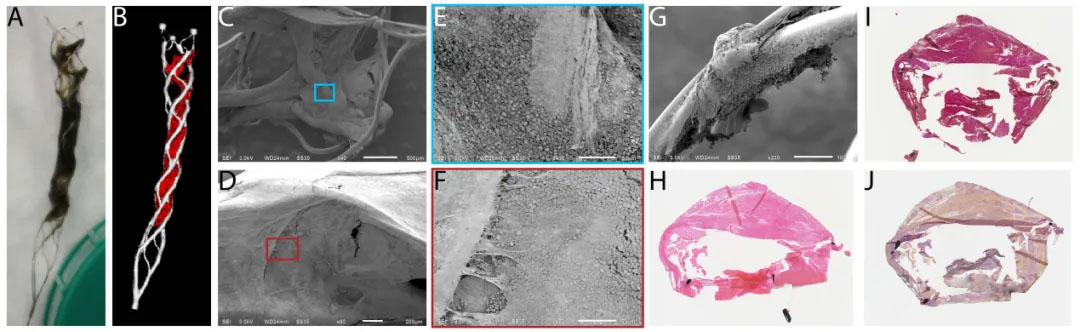 High-Resolution Imaging of Interaction Between Thrombus and Stent-Retriever in Patients With Acute Ischemic Stroke