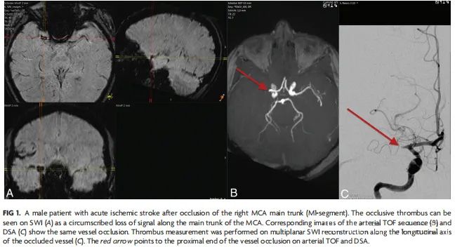 Risks of Undersizing Stent Retriever Length Relative to Thrombus Length in Patients with Acute Ischemic Stroke