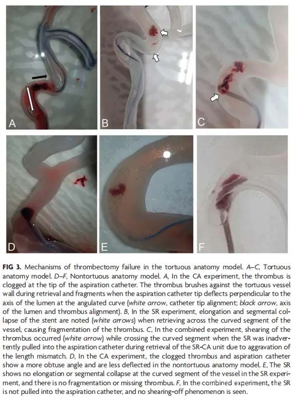 In Vitro Analysis of the Efficacy of Endovascular Thrombectomy Techniques according to the Vascular Tortuosity Using 3D Printed Models