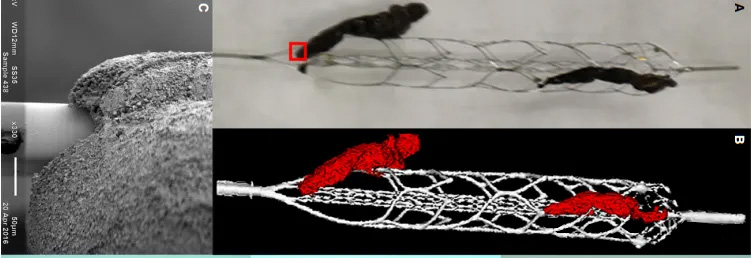 High-Resolution Imaging of Interaction Between Thrombus and Stent-Retriever in Patients With Acute Ischemic Stroke