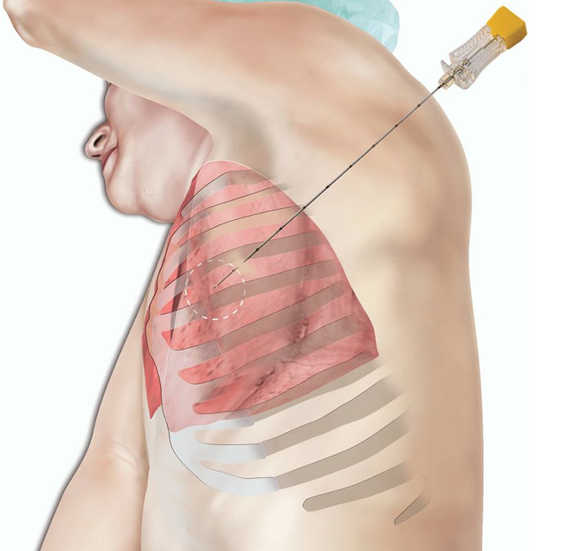  Illustration of a lung biopsy being performed to diagnose abnormal tissue detected in the lungs