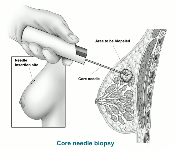 Core Needle Biopsy in Action