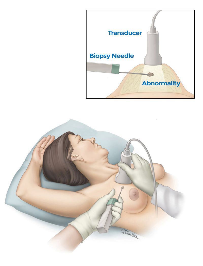 Illustration of a breast biopsy performed using a core needle to extract tissue samples from suspected cancerous tissue