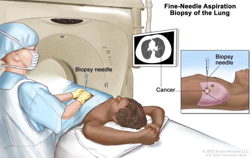 A medical procedure showing fine needle aspiration being used to biopsy tissue from the lungs