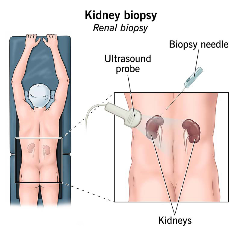 A renal biopsy procedure performed by inserting a biopsy needle into the kidney to extract tissue samples