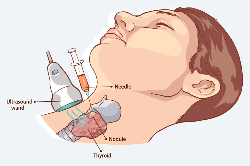 Fine Needle Aspiration in Process