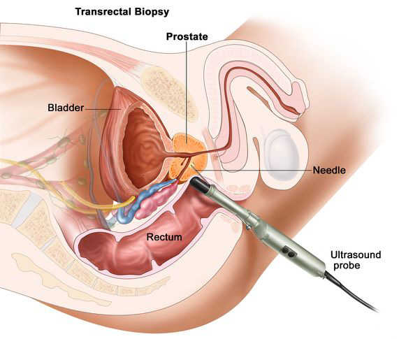 Image showing a prostate biopsy using transrectal ultrasound to guide the needle to the target tissue in the prostate