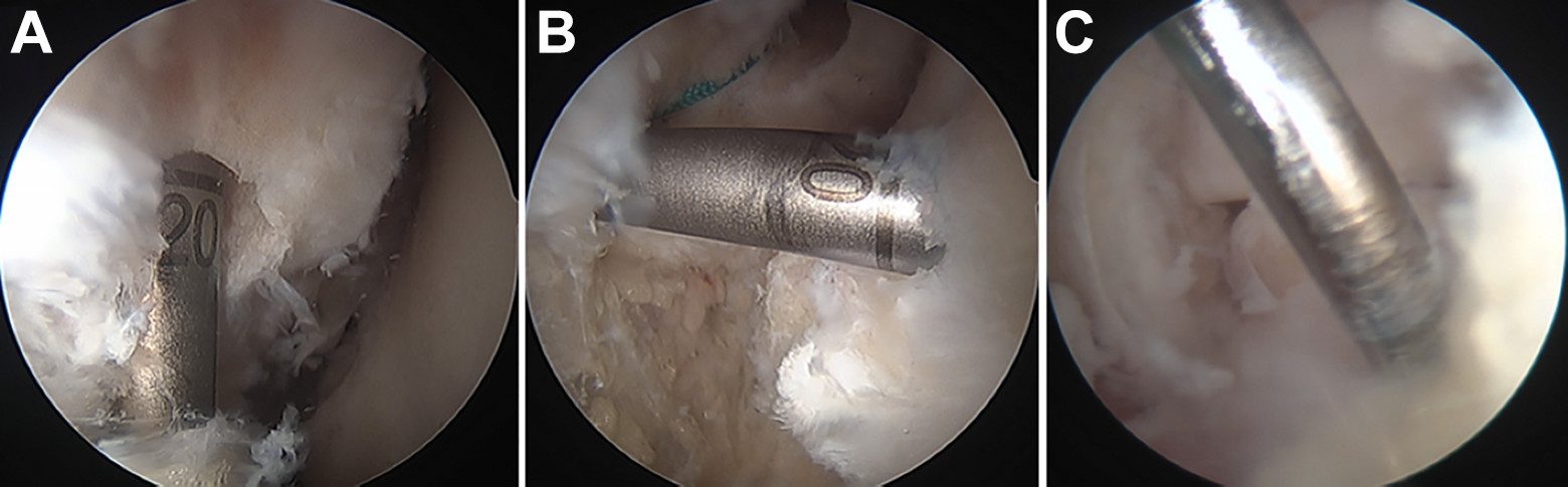 Cannulated Headed Reamer being used in a knee ligament reconstruction procedure to create precise bone tunnels.