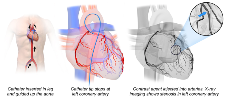 Left Atrial Catheterization