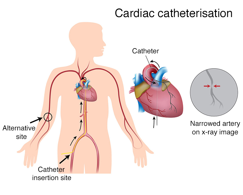 Processing of Left Atrial Catheterization