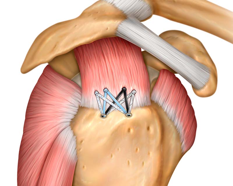 Talon Peek-Ti Knotless Anchors in surgery