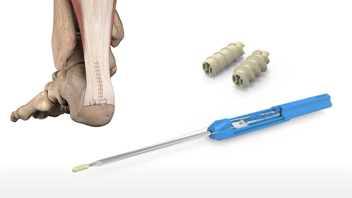 Peek-Force Plus Screw Type Suture Anchors