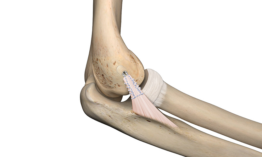 Peek-Force Plus Screw Type Suture Anchors