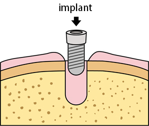 Implant Placement