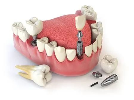  Dental implants