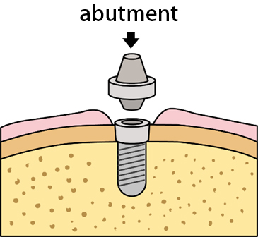  Healing Abutment Installation