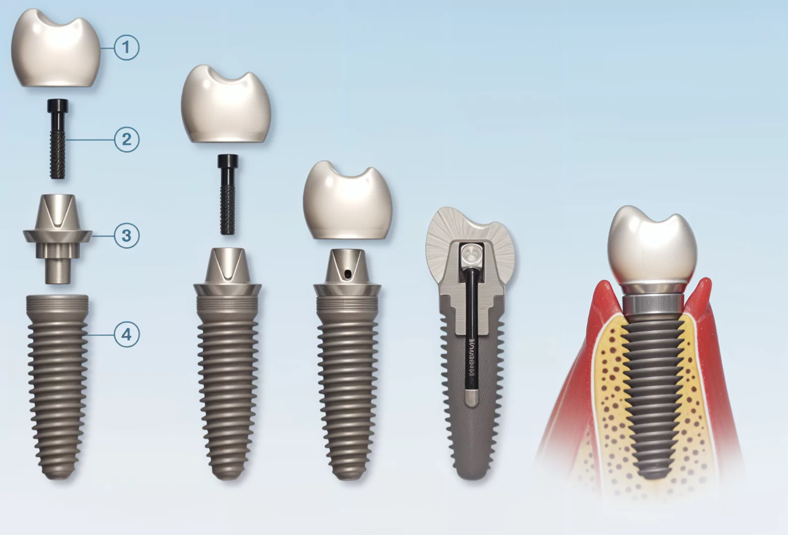 dental implant fixture