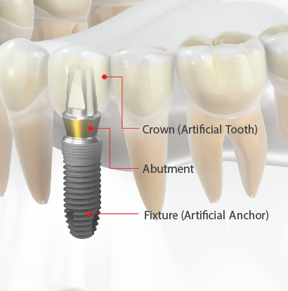 Dental Implants Fixture