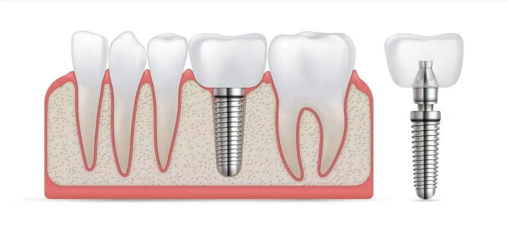  Dental Implants