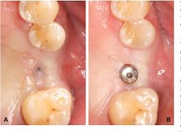  cover screw in dental procedures