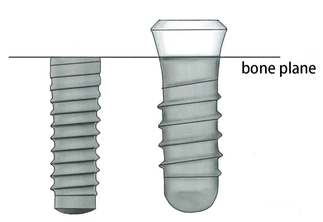 Bone-level