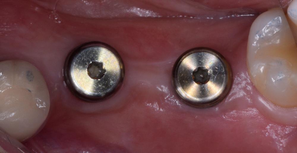 A dental implant with a healing abutment in place, guiding the healing process and shaping the gingiva