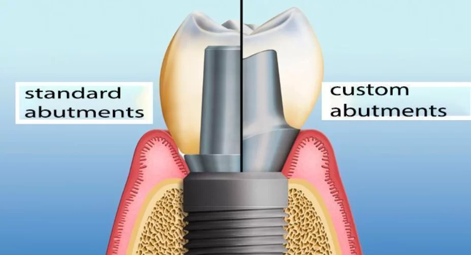 A comparison of standard and customized healing abutments designed to meet specific clinical requirements