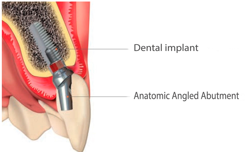 15 degree angled abutment