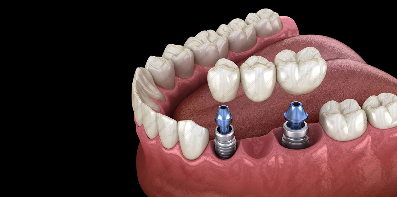 Personalized Abutments application