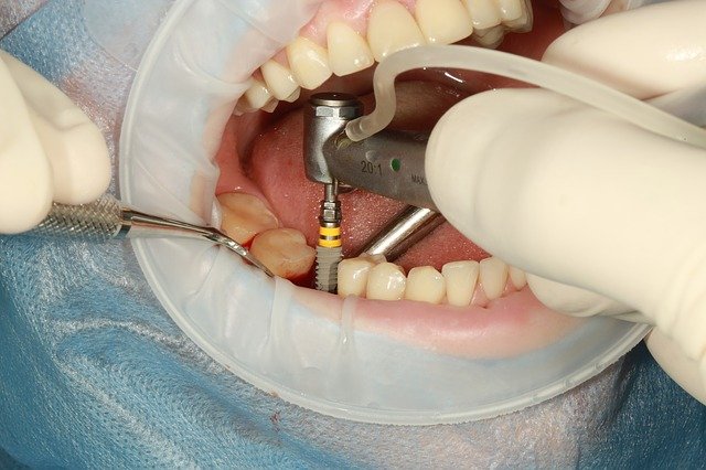 Titanium Dental Implant Posts Applications