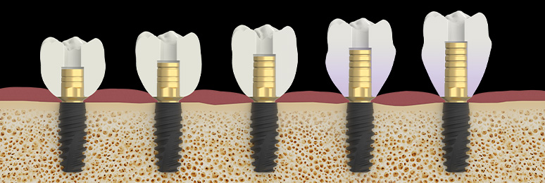 Titanium bases