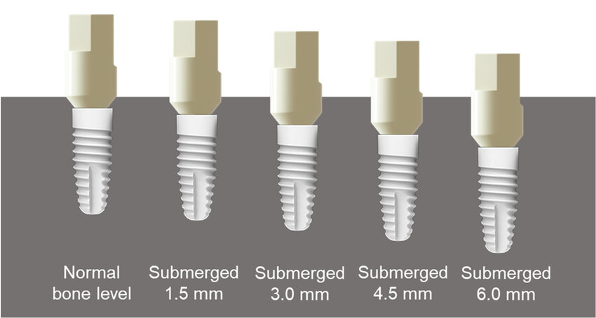  Implant-Level Scan Bodies